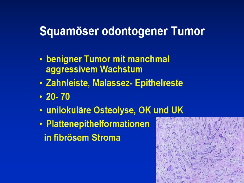 Squamöser odontogener Tumor benigner Tumor mit manchmal aggressivem Wachstum Zahnleiste, Malassez- Epithelreste 20- 70